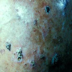 Example of skinLumpsAndBumps